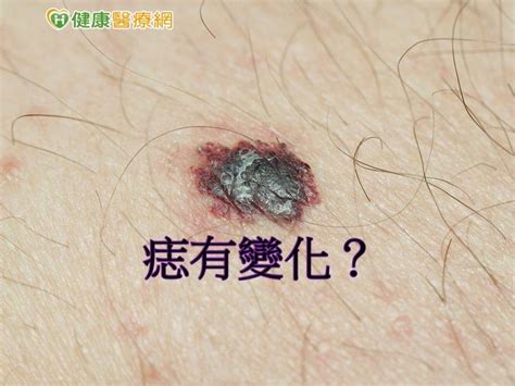 接合痣|痣是什麼？會變成黑色素瘤？7種一定要除的痣